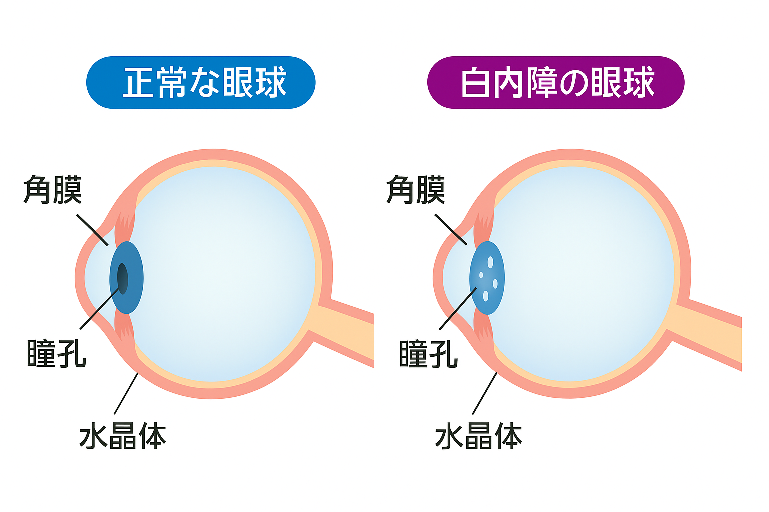 正常な眼球と白内障の眼球の比較