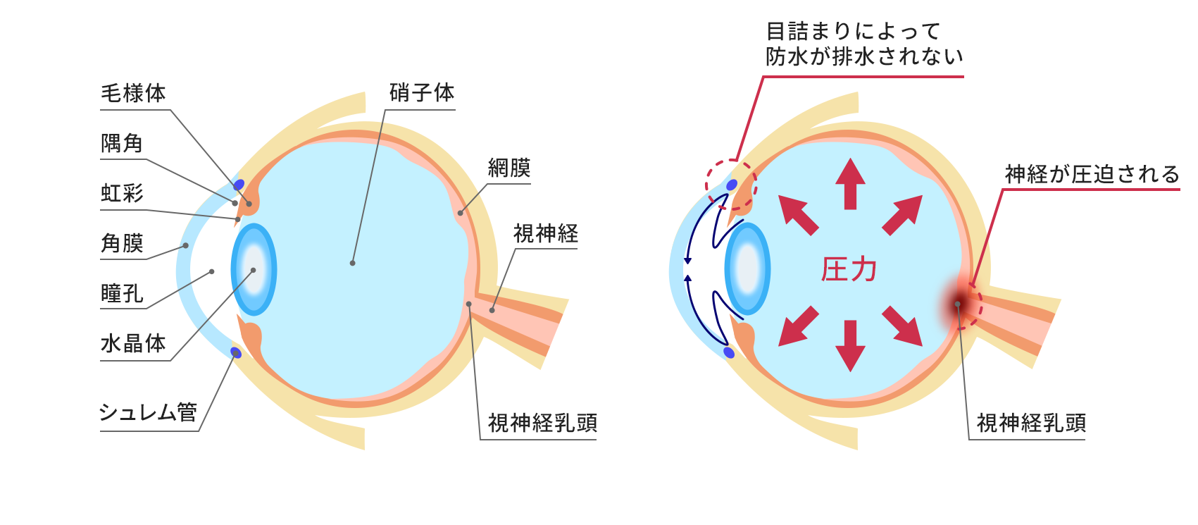 正常な眼球と緑内障の眼球の比較
