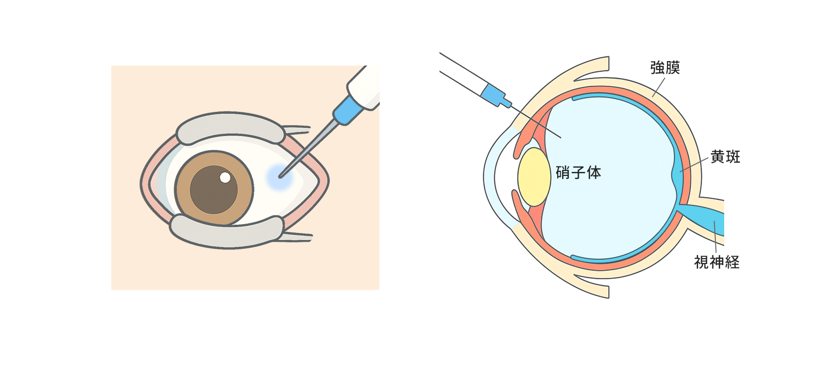 硝子体注射の方法