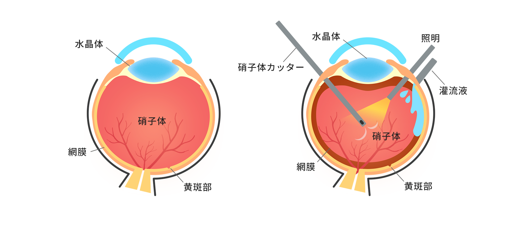 正常な状態・硝子体手術