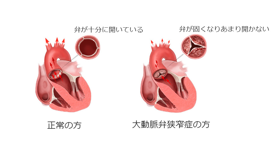 正常な弁との比較