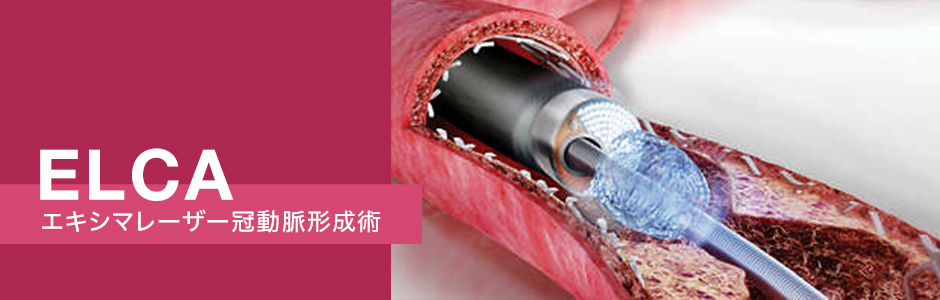 レーザーによる冠動脈治療(ELCA)